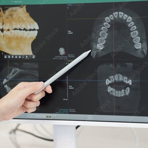 Weisheitszaehne Oralchirurgie Weisheitszaehne Oralchirurgie